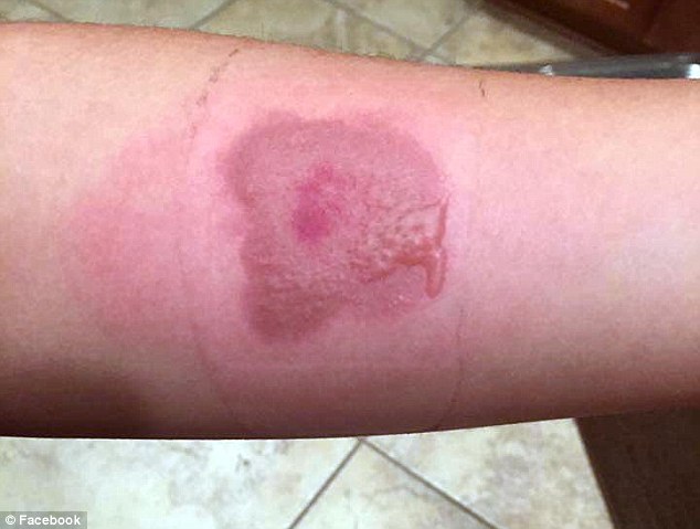 3C77966000000578-4152220-Lasting_damage_Images_posted_on_Facebook_show_the_marks_left_by_-a-9_1485293609042
